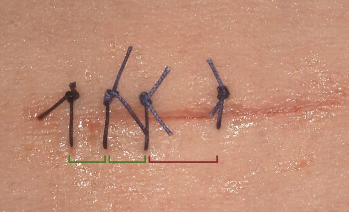 simple interrupted suture for 101 Survival Hacks